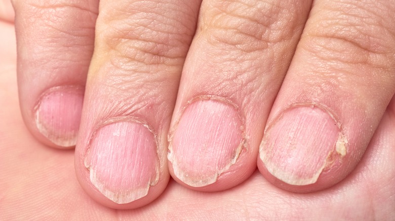 Dry and brittle nails