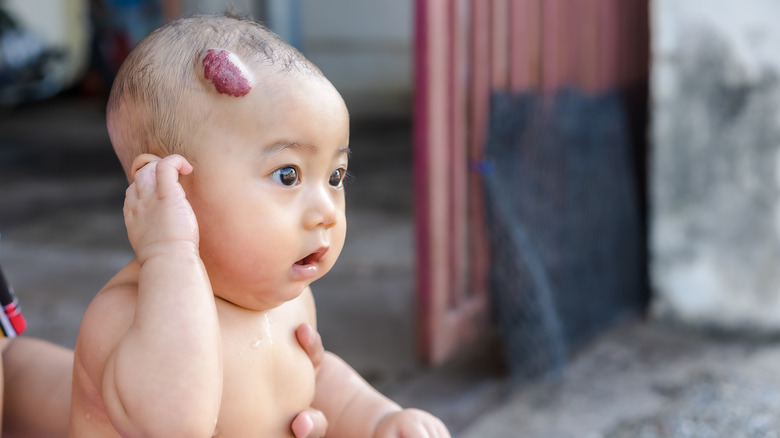 Baby with hemangioma on head