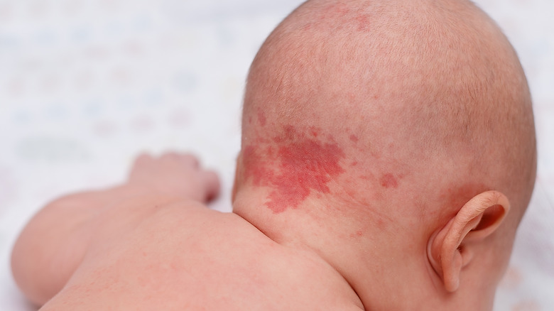 Birthmark on baby's neck