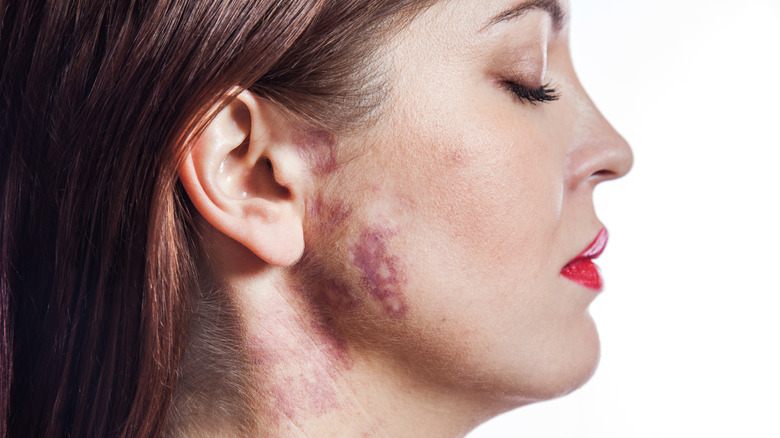 Woman with port-wine stain on face