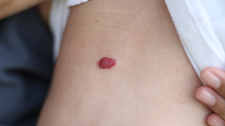 Hemangioma on a baby's back