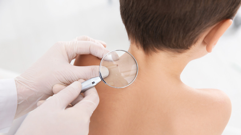Dermatologist examining boy's birthmark