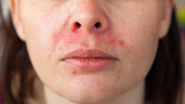 woman with perioral dermatitis