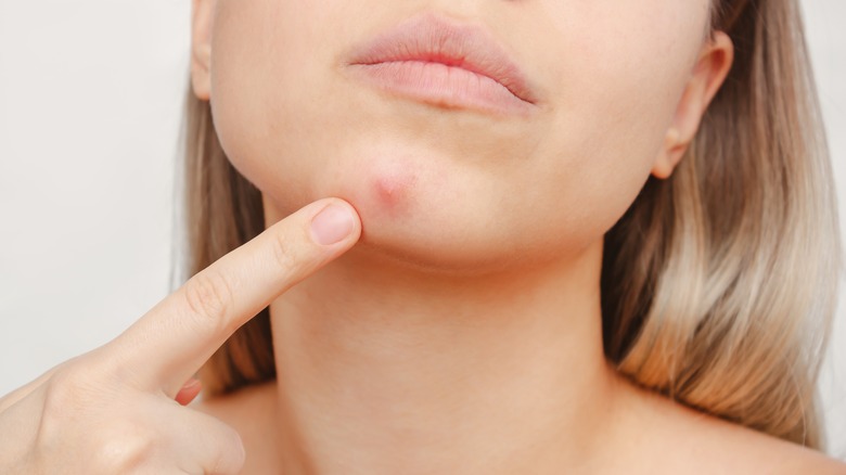 Girl pointing to a cystic pimple.