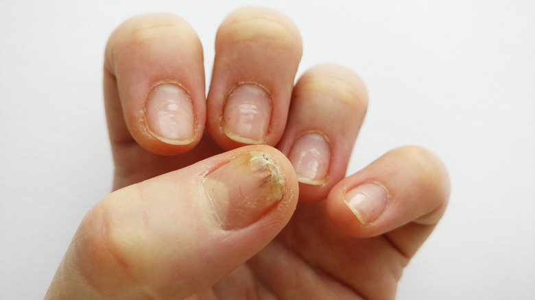 Closeup of cracked, peeling fingers and nails