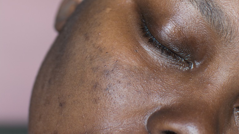 Black woman's skin with hyperpigmentation