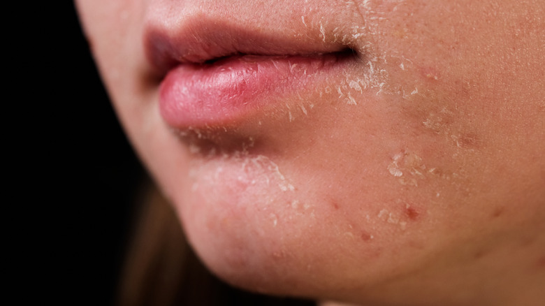 Dry, flaky skin on chin