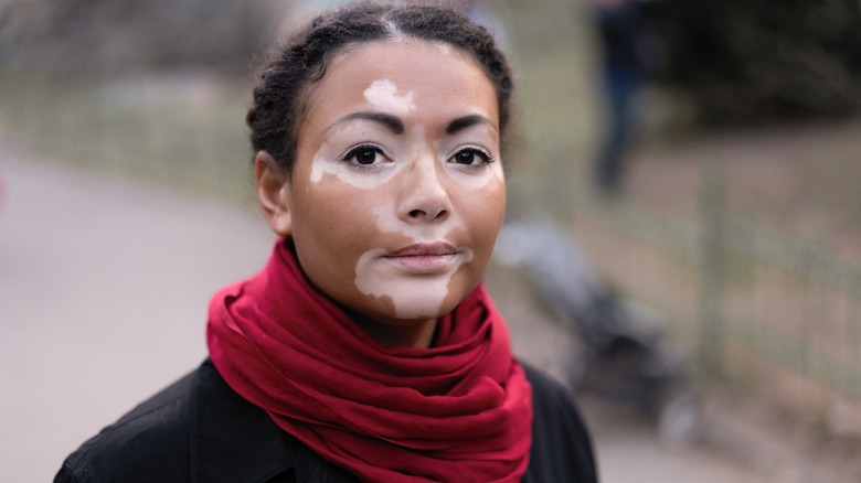 Woman with vitiligo