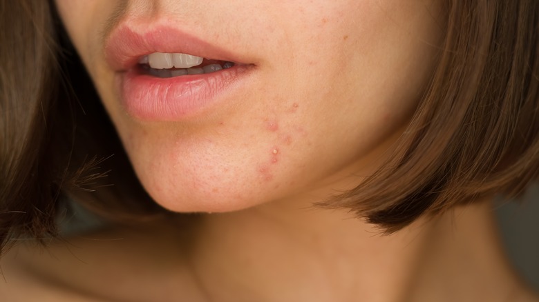 woman with acne 