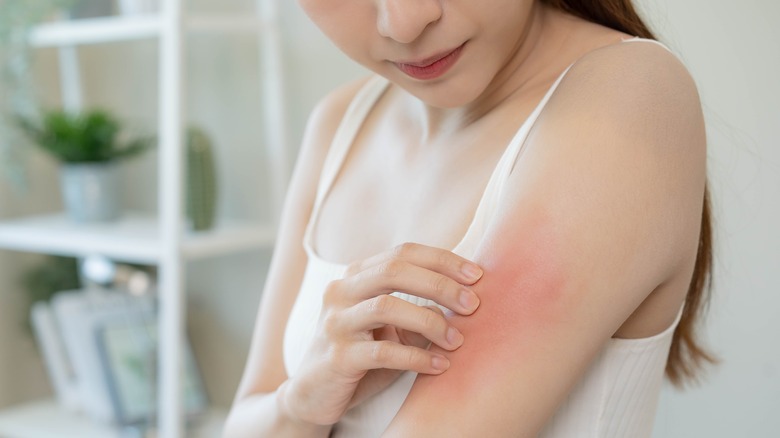 Woman with red, inflamed arm