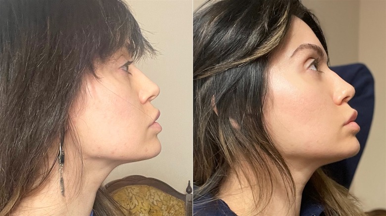 Before and after using Omnilux Contour Face