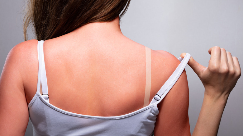 Woman with sunburnt back