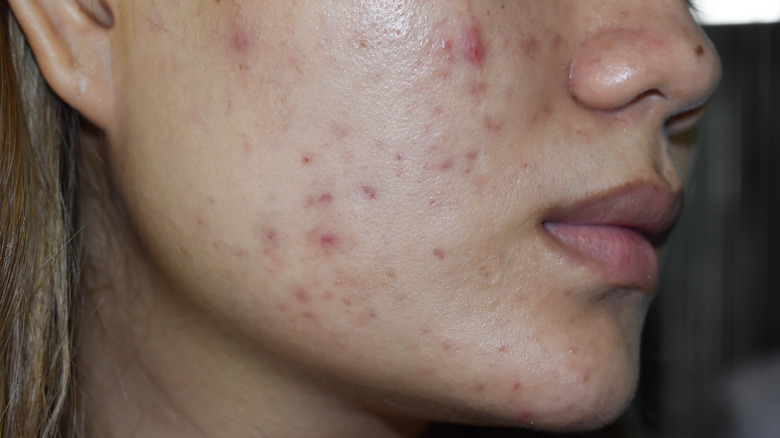 Model with acne and acne scarring