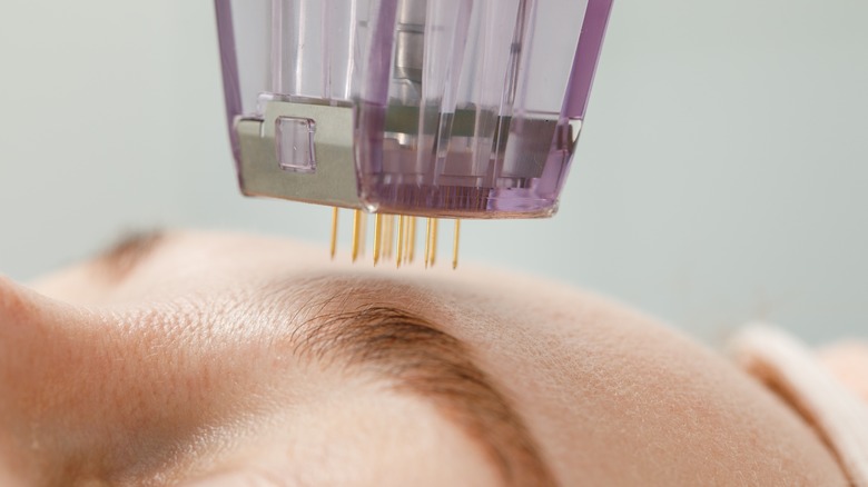 person having microneedling procedure