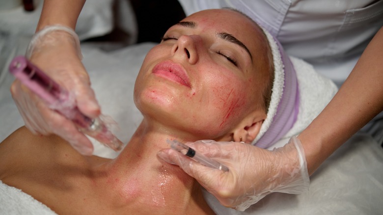 person having microneedling procedure