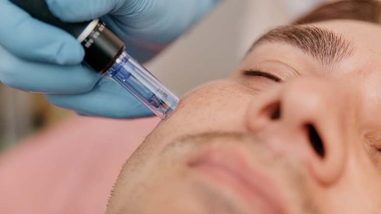 man having microneedling procedure