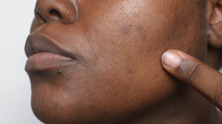 woman with hyperpigmentation