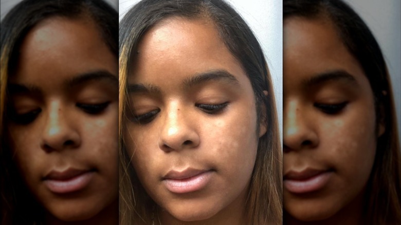 tinea versicolor on cheeks