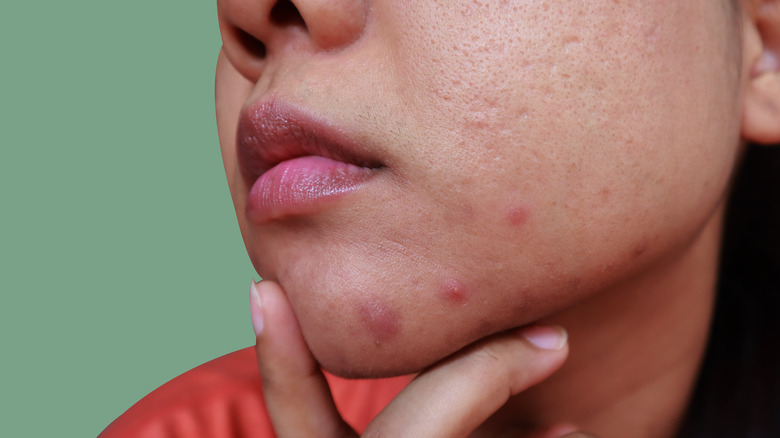 Person with cystic acne.