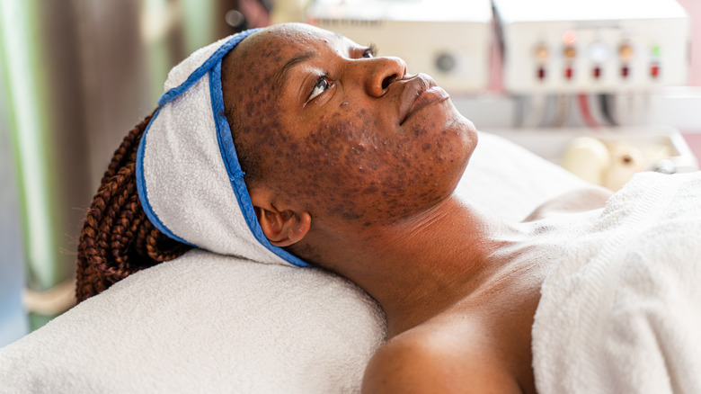 Woman with acne scars.