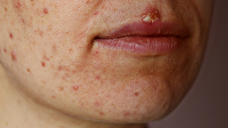 female with cold sores acne around the lips