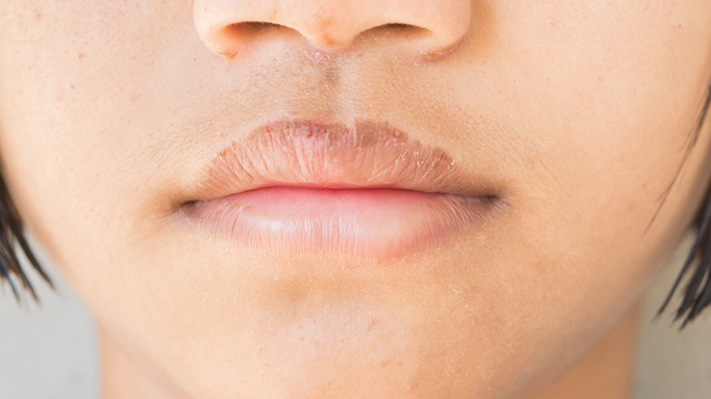 woman with dry and dark upper lip 