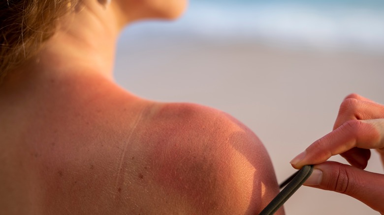 Girl on the beach with sunburn