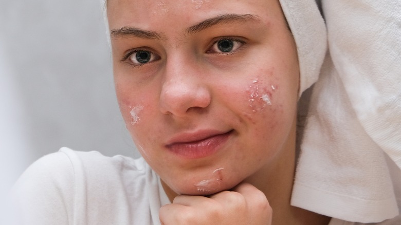 female having acne