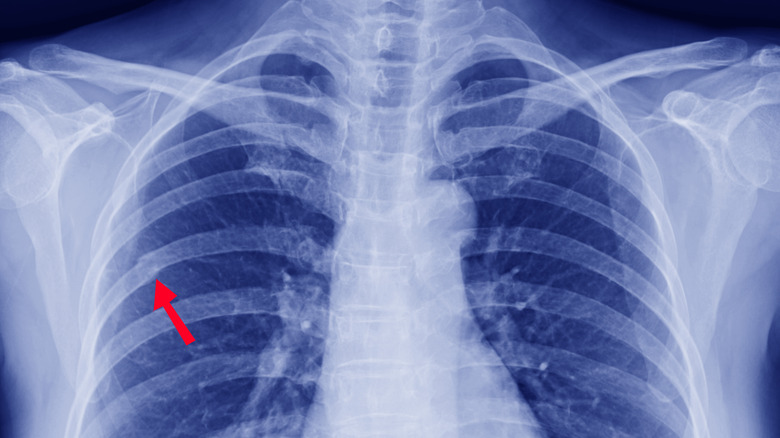 X-ray of a rib fracture