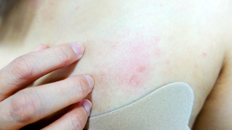 Skin rash on person's breast