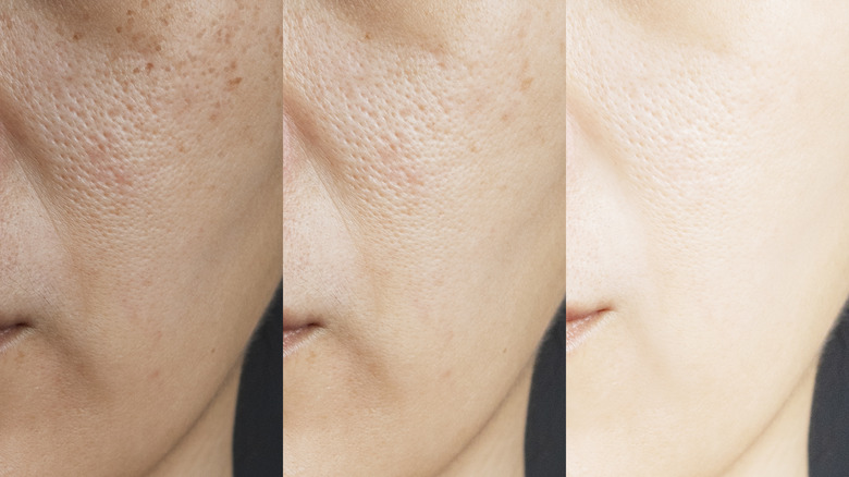 Progressive brightening of discolored skin 