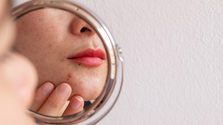 Worried woman checking her acne