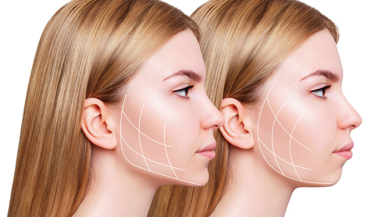 Illustration chin filler results