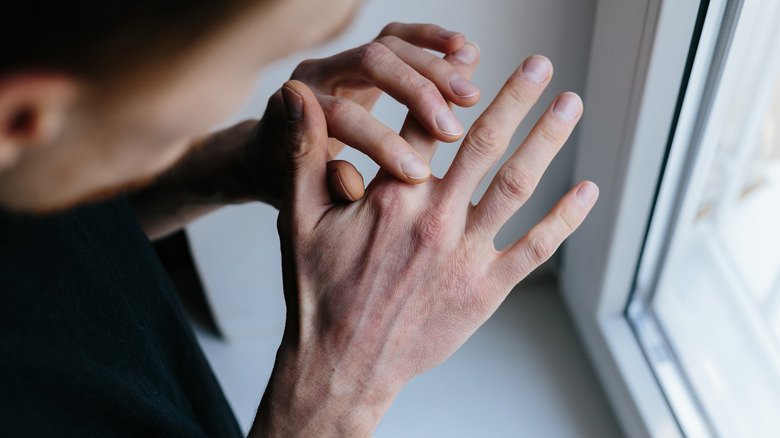 Man scratching dry hands