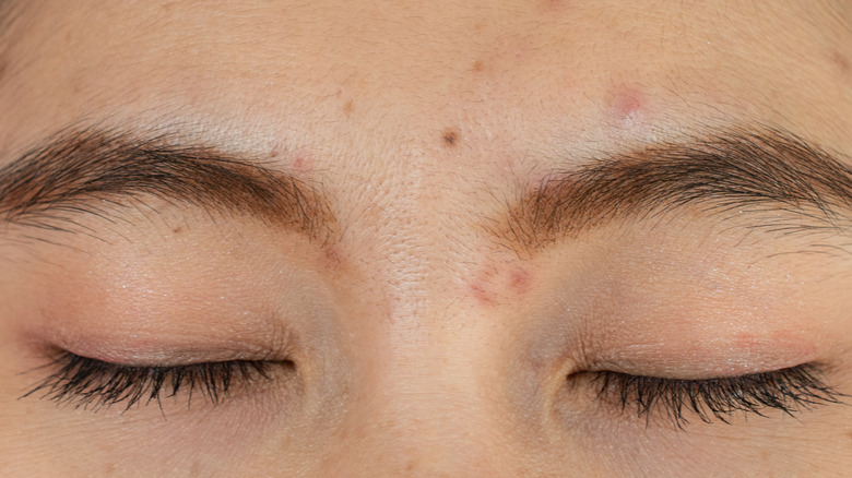 closed eyes with pimples between eyebrows