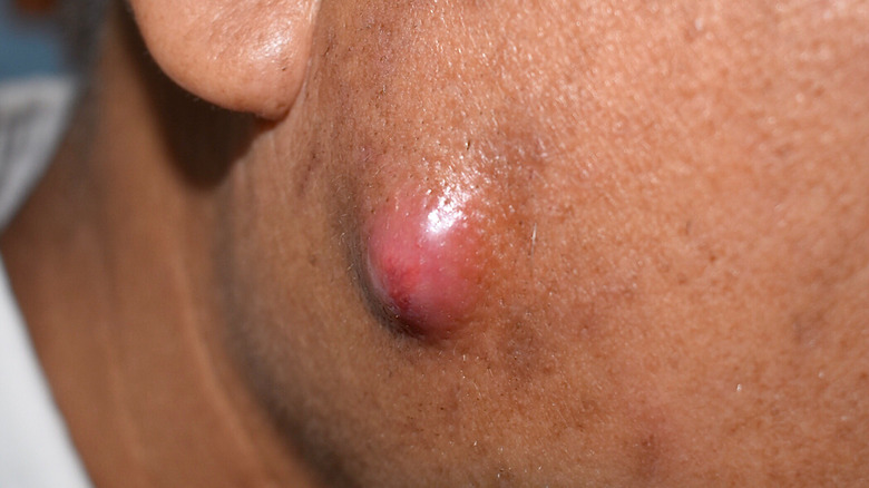 swelling bump bacterial skin infection 