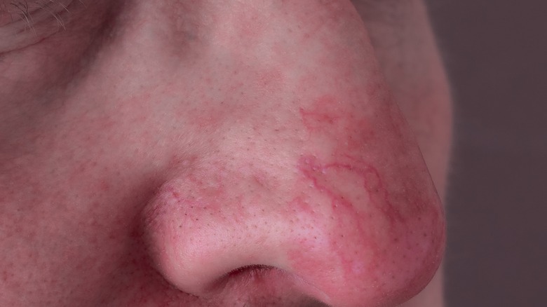 Rosacea in male nose