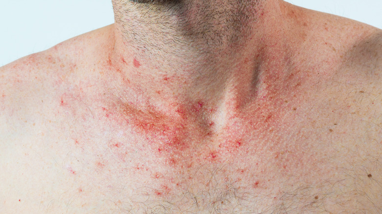 spider veins on a male neck