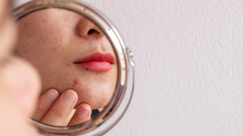 Person looking at acne in mirror