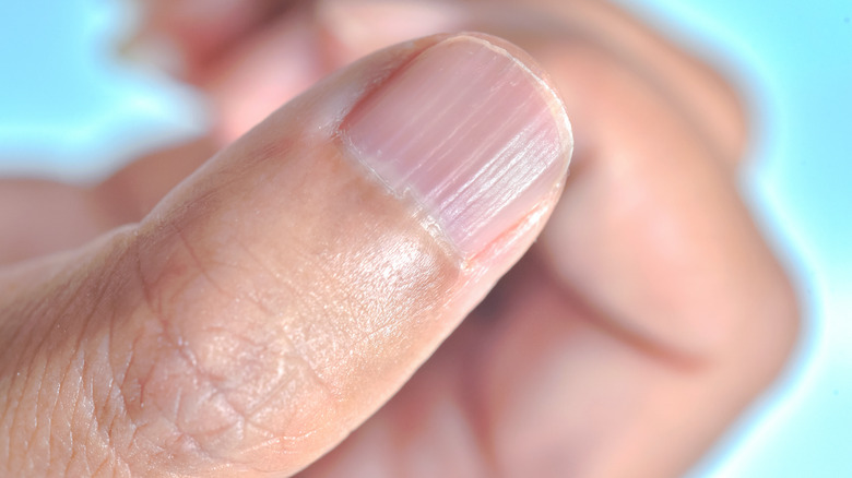 Fingernail Ridges Causes And Treatments For Vertical And Horizontal 