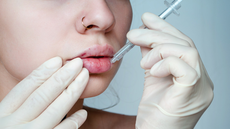 Post-lip injection patient shows bruising on lips