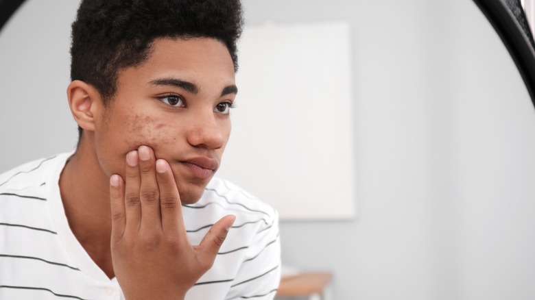 teenage boy treating his skin