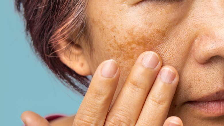 Woman examining spots on skin