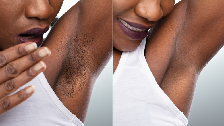 Before and after laser treatment on dark skin