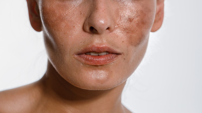 hyperpigmentation on skin