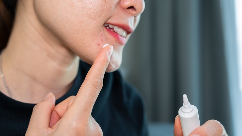 woman applying acne spot treatment