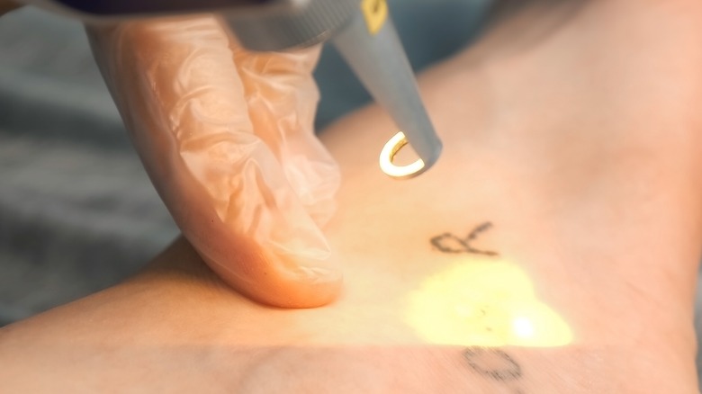 tattoo removal 