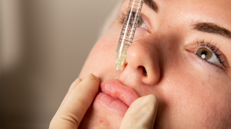 Vertical hyaluronic lip filler injection