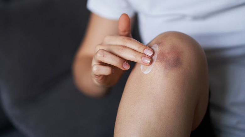 Woman applying cream to bruised knee