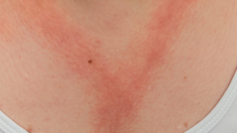 neck contact dermatitis from necklace